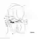 Fig. 07 - Arrangement and method used in the preparation of the proximal surface of the tibia for the tibial component of a prosthetic knee joint