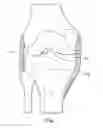 Fig. 02 - System and method for load balancing in knee replacement procedures