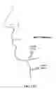Fig. 131 - Pixel array medical systems, devices and methods
