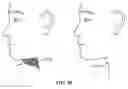 Fig. 85 - Pixel array medical systems, devices and methods