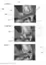 Fig. 04 - Uterine manipulator