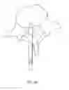 Fig. 13 - Bone anchor delivery systems and methods
