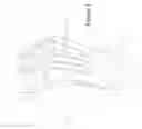 Fig. 02 - Method of correcting hallux varus joint deformity