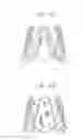Fig. 06 - Prosthetic heart valve with cusp positioners