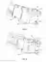 Fig. 08 - Expanding interbody implant and articulating inserter and method