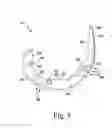 Fig. 06 - System including femoral augment trials and method of performing an orthopaedic joint replacement procedure