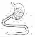 Fig. 01 - A DEVICE FOR TREATING OBESITY AND A CORRESPONDING DELIVERY SYSTEM
