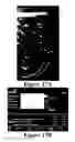 Fig. 16 - Methods of reducing mammographic breast density and/or breast cancer risk