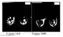 Fig. 33 - Methods of reducing mammographic breast density and/or breast cancer risk