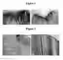 Fig. 02 - USE OF POLYMERIC MATERIAL TO REPAIR OSTEOCHONDRAL DEFECTS