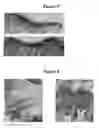 Fig. 04 - USE OF POLYMERIC MATERIAL TO REPAIR OSTEOCHONDRAL DEFECTS