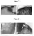 Fig. 05 - USE OF POLYMERIC MATERIAL TO REPAIR OSTEOCHONDRAL DEFECTS