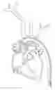 Fig. 01 - VESSEL ACCESS CATHETER