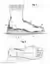 Fig. 02 - Orthotic Insert Device