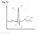 Fig. 09 - System and method for providing dynamic gain over non-noise electrocardiographic data with the aid of a digital computer