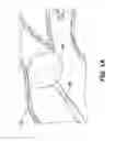 Fig. 02 - CATHETER BALLOON EMPLOYING FORCE SENSING ELEMENTS