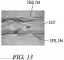 Fig. 10 - Clot retrieval system