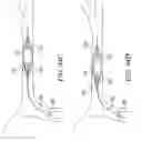 Fig. 48 - Clot retrieval system