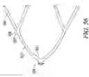 Fig. 73 - Clot retrieval system
