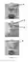 Fig. 06 - Super elastic, bioabsorbable endovascular devices