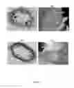 Fig. 08 - Super elastic, bioabsorbable endovascular devices
