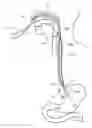 Fig. 01 - Acoustic reflectometry device in catheters