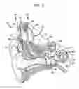 Fig. 02 - Event detection in an implantable auditory prosthesis