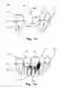 Fig. 02 - Computer implemented planning and providing of mass customized bone structure