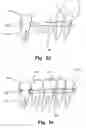 Fig. 07 - Computer implemented planning and providing of mass customized bone structure