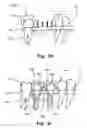 Fig. 09 - Computer implemented planning and providing of mass customized bone structure