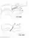 Fig. 49 - Vertebral joint implants and delivery tools