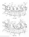 Fig. 08 - Method and apparatus for minimally invasive posterolateral spinal fusion
