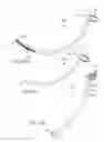 Fig. 30 - Method and apparatus for minimally invasive posterolateral spinal fusion