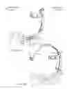 Fig. 32 - Method and apparatus for minimally invasive posterolateral spinal fusion