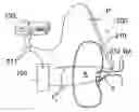 Fig. 01 - Renal neuromodulation for treatment of human patients