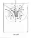 Fig. 49 - Method of treating urinary incontinence by anchoring a support to periosteum tissue