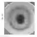 Fig. 65 - Prosthetic capsular devices, systems, and methods