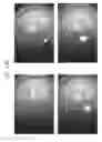 Fig. 69 - Prosthetic capsular devices, systems, and methods