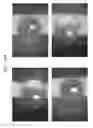 Fig. 71 - Prosthetic capsular devices, systems, and methods