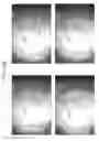 Fig. 72 - Prosthetic capsular devices, systems, and methods