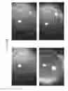 Fig. 76 - Prosthetic capsular devices, systems, and methods