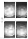 Fig. 77 - Prosthetic capsular devices, systems, and methods