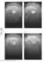 Fig. 83 - Prosthetic capsular devices, systems, and methods