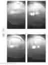 Fig. 89 - Prosthetic capsular devices, systems, and methods