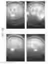 Fig. 97 - Prosthetic capsular devices, systems, and methods