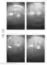 Fig. 99 - Prosthetic capsular devices, systems, and methods