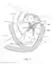Fig. 02 - Transcatheter mitral valve prosthesis
