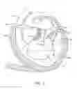 Fig. 04 - Transcatheter mitral valve prosthesis