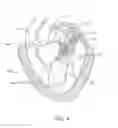 Fig. 06 - Transcatheter mitral valve prosthesis