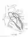 Fig. 32 - Transcatheter mitral valve prosthesis